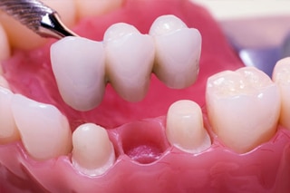  CDCP dentist in Mississauga offers CDCP covered Tooth replacement services 